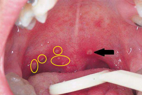 儿童扁桃体疱疹图片图片