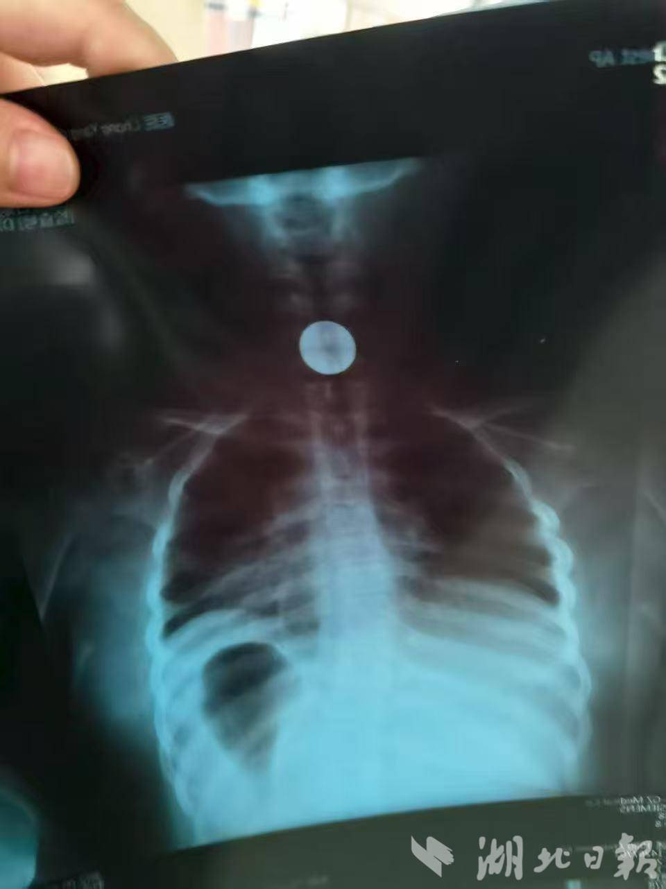 崇阳10岁女孩误吞1元硬币！返乡“85”后医生3分钟成功取出-腾讯新闻
