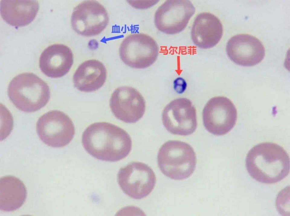 巨型血小板图片