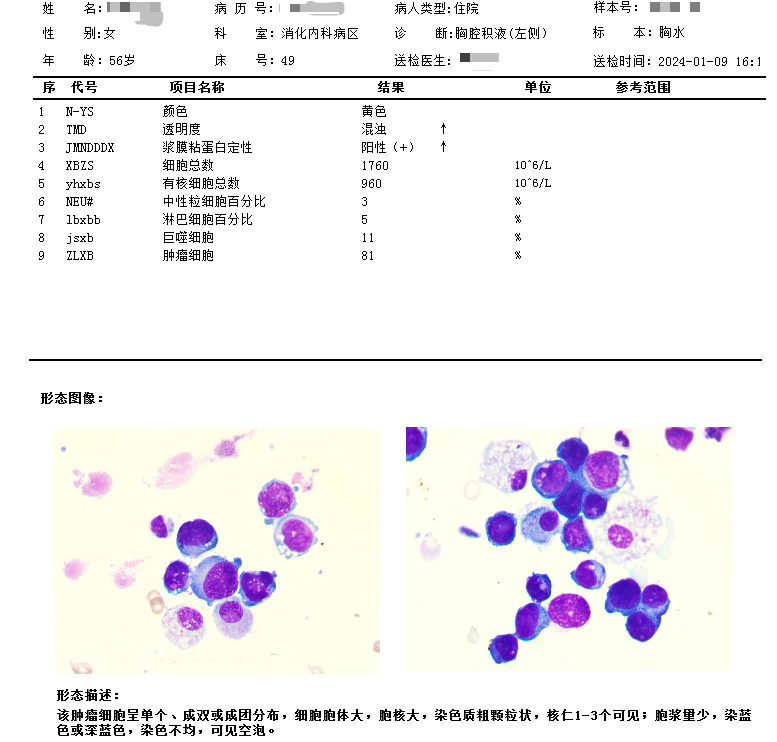 (右侧)常规查见肿瘤细胞报告,如下图1患者入院后血常规:血红蛋白89g/l