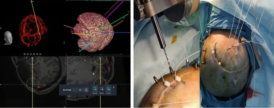 医疗机器有哪些发力手术机器人，联影一天拿下9项专利_https://www.jmylbn.com_新闻资讯_第3张