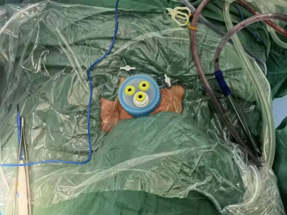 经过与家属充分沟通,田凯华教授在张东旸主治医师,徐汉林主治医师,曲