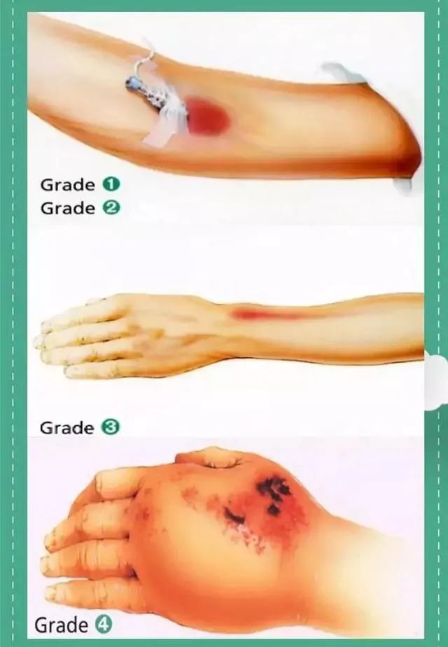 临床常见各种液体外渗如何紧急处置