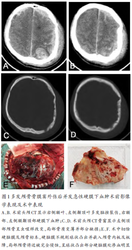 多发颅骨骨膜窦外伤后并发急性硬膜下血肿1例