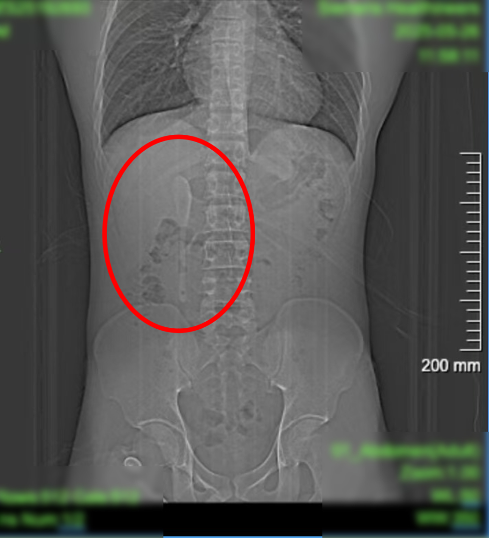 男子腹中惊现 15cm 长咖啡勺半年，原