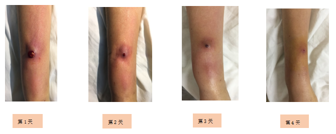 什么是无菌针警惕！留置针拔除后，可别忽略了对穿刺点的观察-上海聚慕医疗器械有限公司