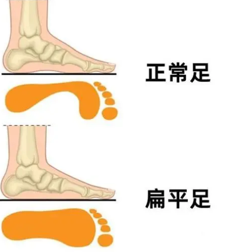 看得出林志玲脚掌非常大之余足弓也偏低,有些扁平足