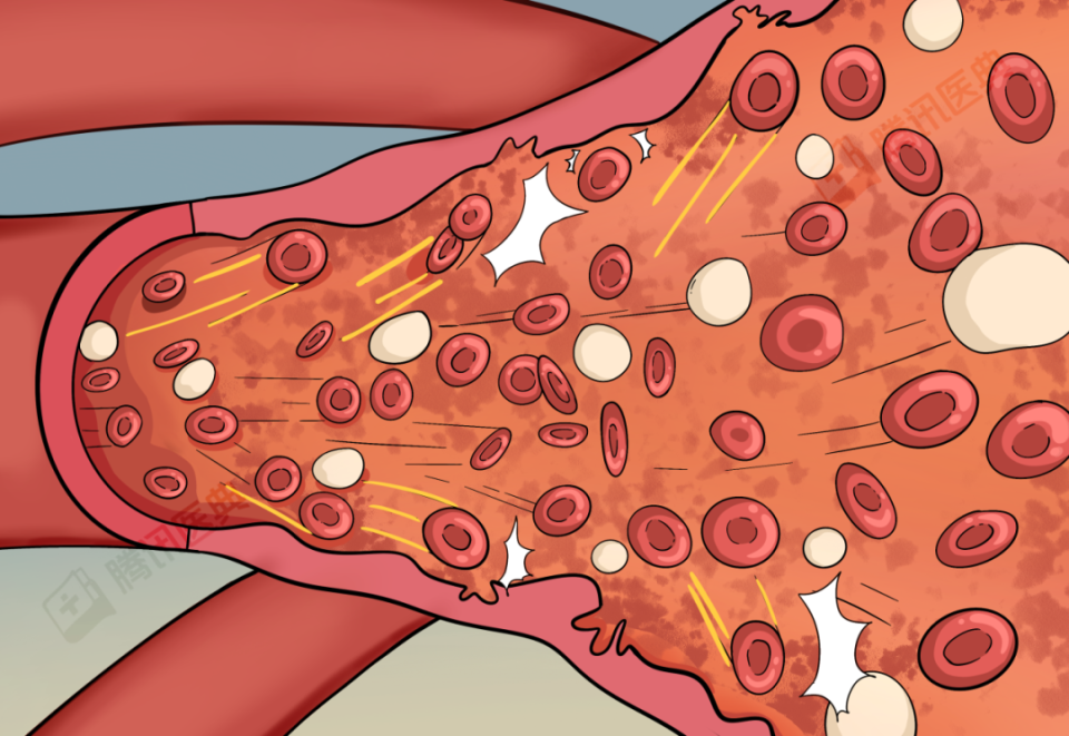 出现这6个症状,警惕血管堵塞!