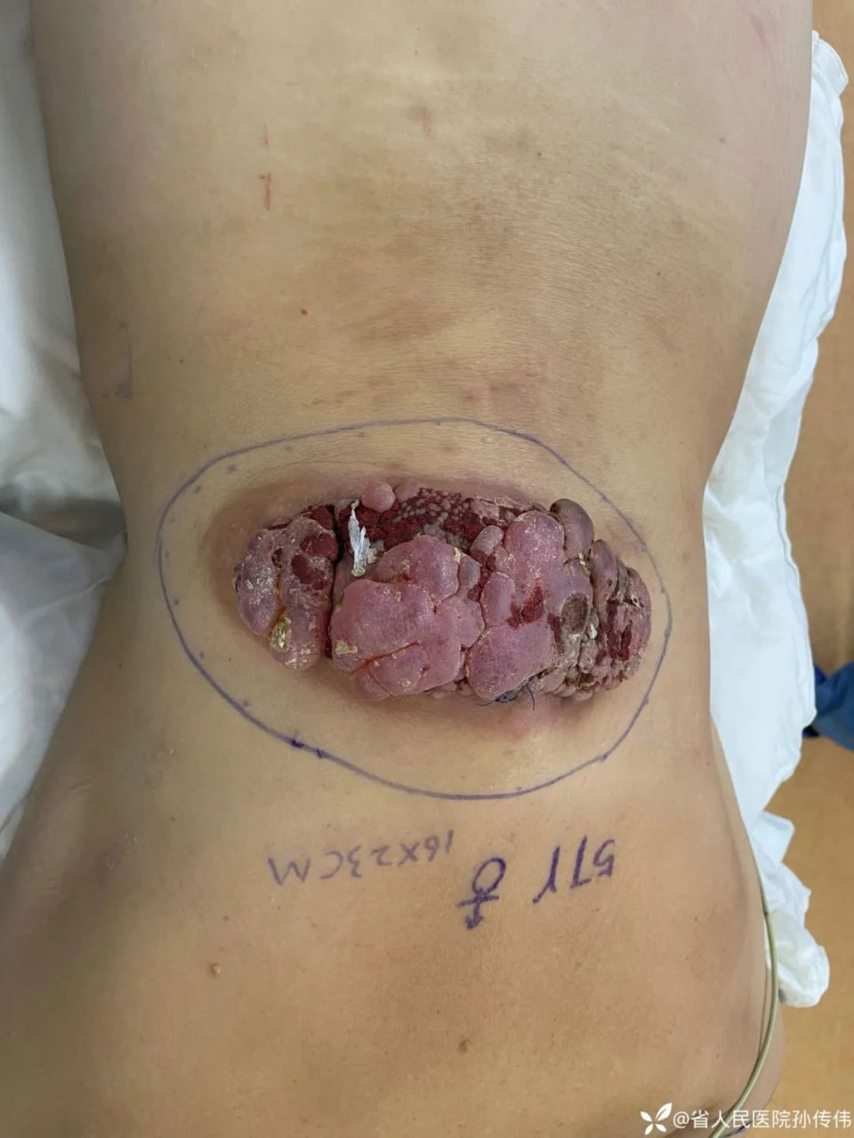 接诊背部长满「菜花」的患者,最后发现竟误诊 4 年