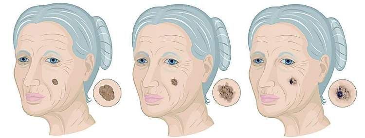 那时,梁阿婆右侧鼻背长出来了一块黑色皮肤肿物,在当地医院进行了激光