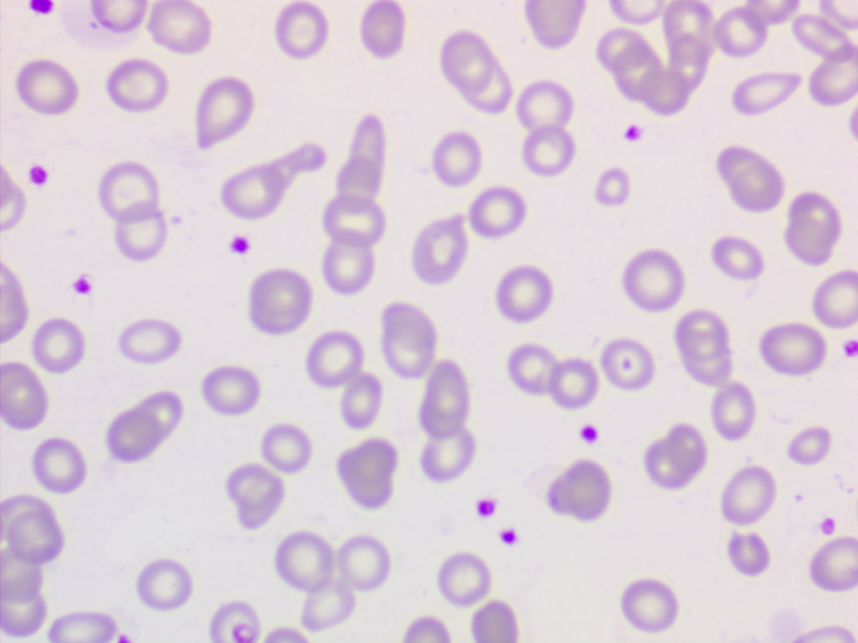 图1 血常规分析结果血涂片镜检:镜下可见白细胞明显减少,多个视野不