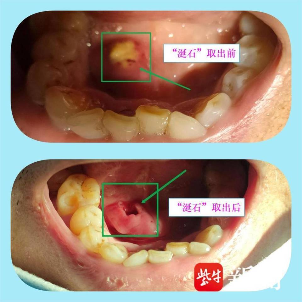 组织已开始红肿,原来是导管结石导致的炎症,也就是平常所说的"涎石病"