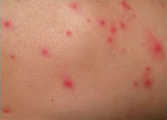 第三种:毛囊炎已经长痱子了,可以外用炉甘石洗剂,如果继发感染也可以