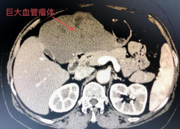 肝血管瘤图片肝部图片