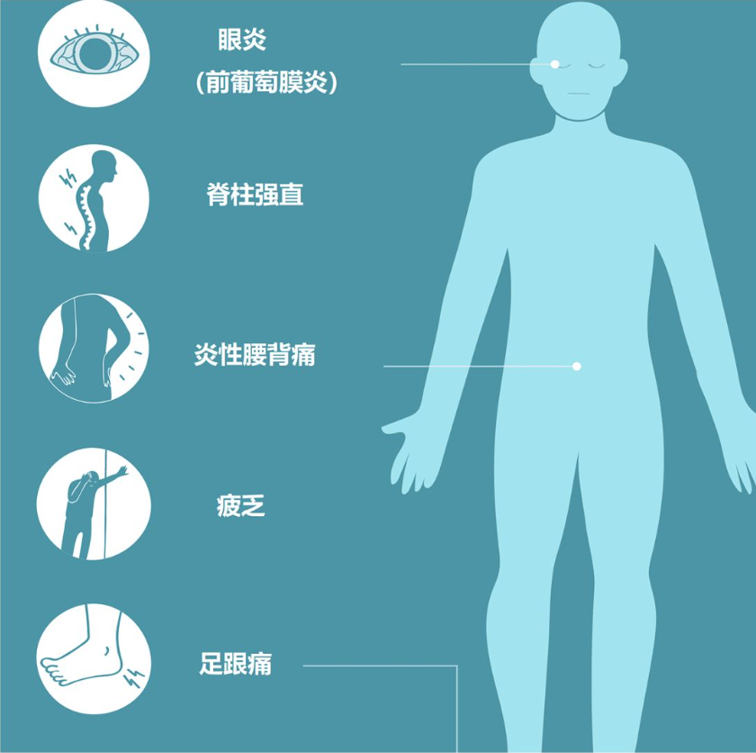 67强直性脊柱炎,手术能否一劳永逸地解决呢?