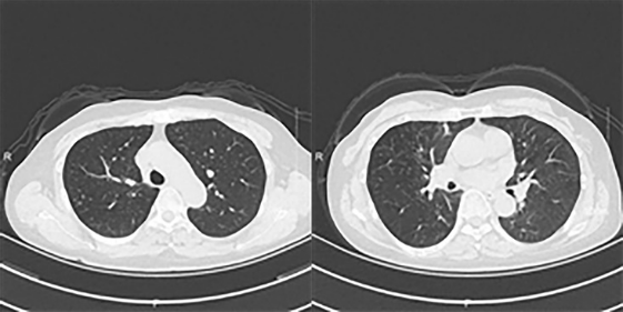 ct显示双肺支气管壁增厚伴分泌物,右肺上叶多发小结节,两肺少许纤维灶