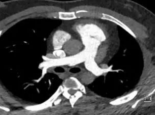 呼吸机怎么打开Ⅱ型呼吸衰竭又陷诊断困局……当室速撞上呼吸“牢笼”，如何通过破解隐匿的神经肌肉密码打开思路，拨云见日？丨疑案探密（161）_https://www.jmylbn.com_新闻资讯_第1张