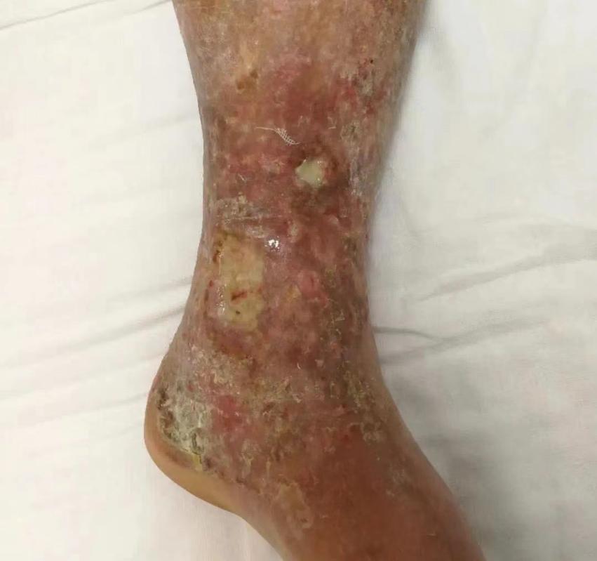 老烂腿湿疹瘙痒溃烂能治好吗?_腾讯新闻