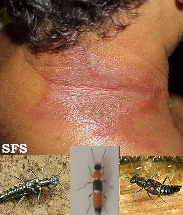 虫咬严重可致命!身上的不明红包要小心