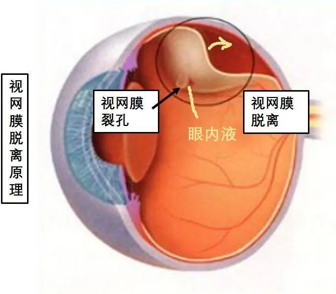 视网膜脱落照片图片