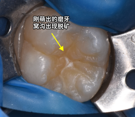 想要窝沟封闭效果更好,得注意这几点!