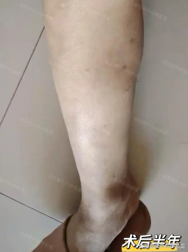 56岁要做静脉曲张微创,家人说我"想不开",6个月后都是惊喜