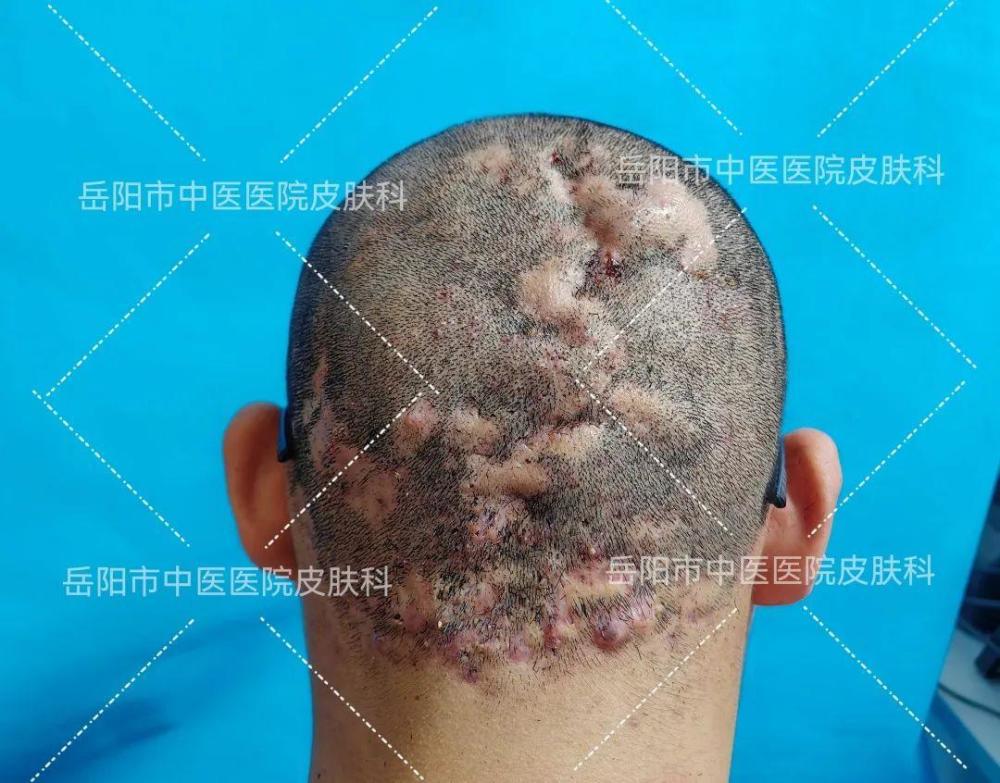 男子毛囊炎"久治不愈",没想到竟被中医成功治愈_腾讯新闻