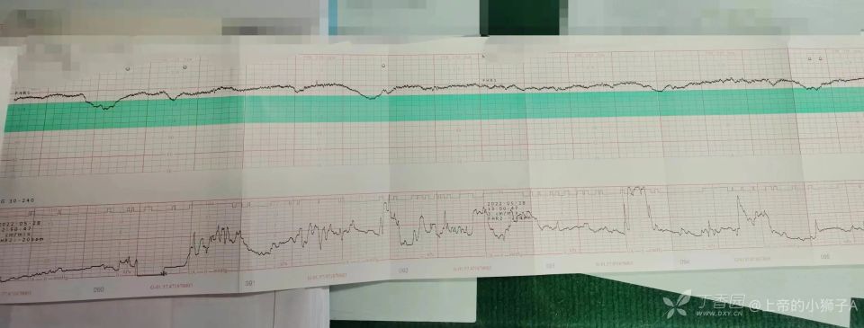 宫口开大4cm羊水清亮这样的胎监该不该继续试产