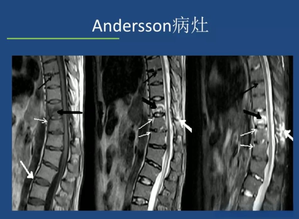 强直性脊柱炎,常见7个临床问答看这篇!