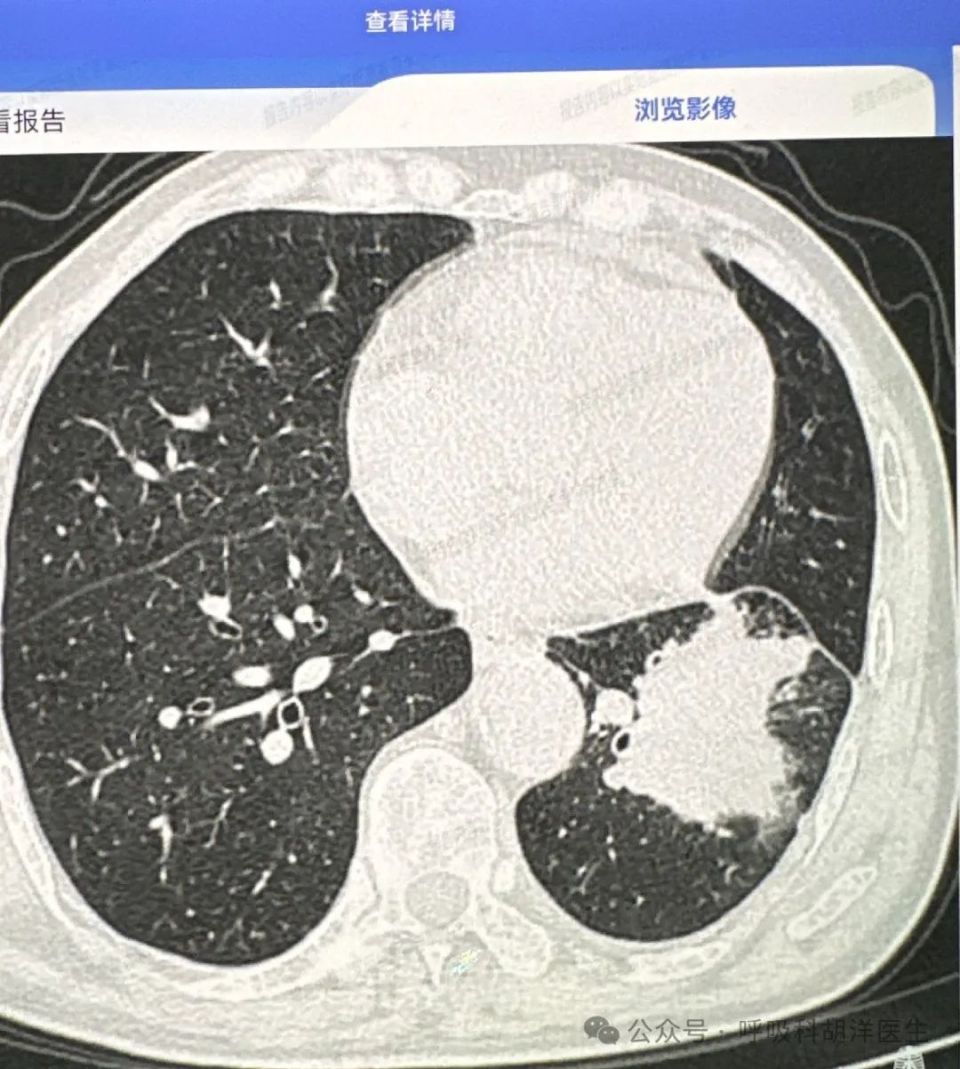 但没有哪种方法能够根治晚期肺癌,多数治疗仍然以维持生命控制肿瘤