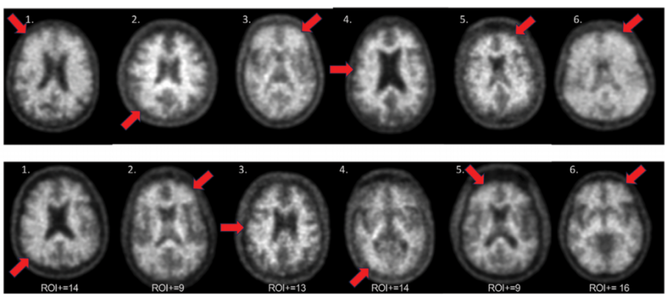 AD：科学家发现，Aβ PET是比Aβ脑脊液生物标志物更灵敏、更准确的Aβ沉积检测方法！_腾讯新闻
