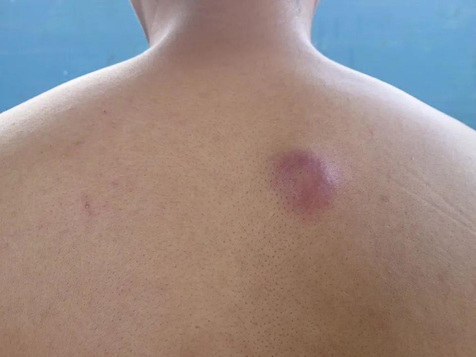 又红又肿,一碰就痛!长了火疖子别做这件事