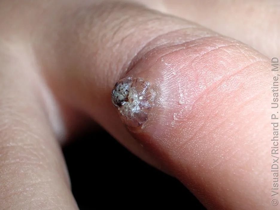 脖子上长这种小肉粒,不是普通皮肤病,可能感染了hpv!