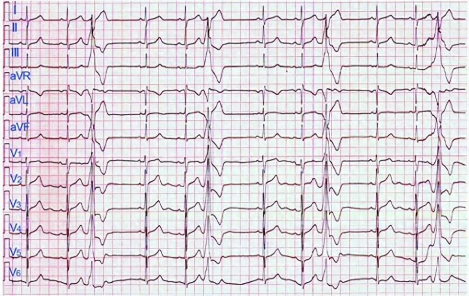 心里总是"咯噔"一下?一篇文章带你科学认识"室性早搏"