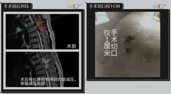 湘潭市第一人民医院脊柱手术微创化