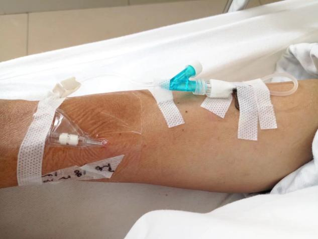 该怎么拯救你:被"强拉硬拽"的留置针?