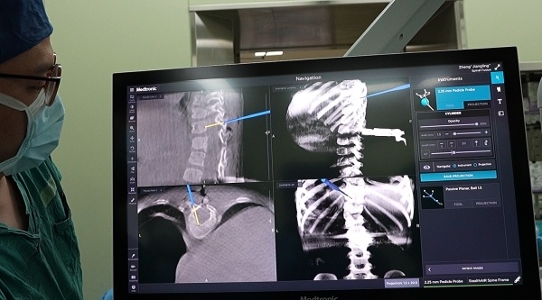 全国儿童专科医院首例o型臂 s8手术导航系统辅助,精准施救3岁先天脊柱