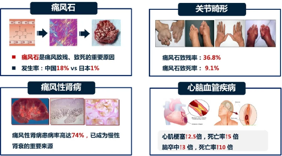 "痛"定思"痛,和您聊聊痛风那些事儿