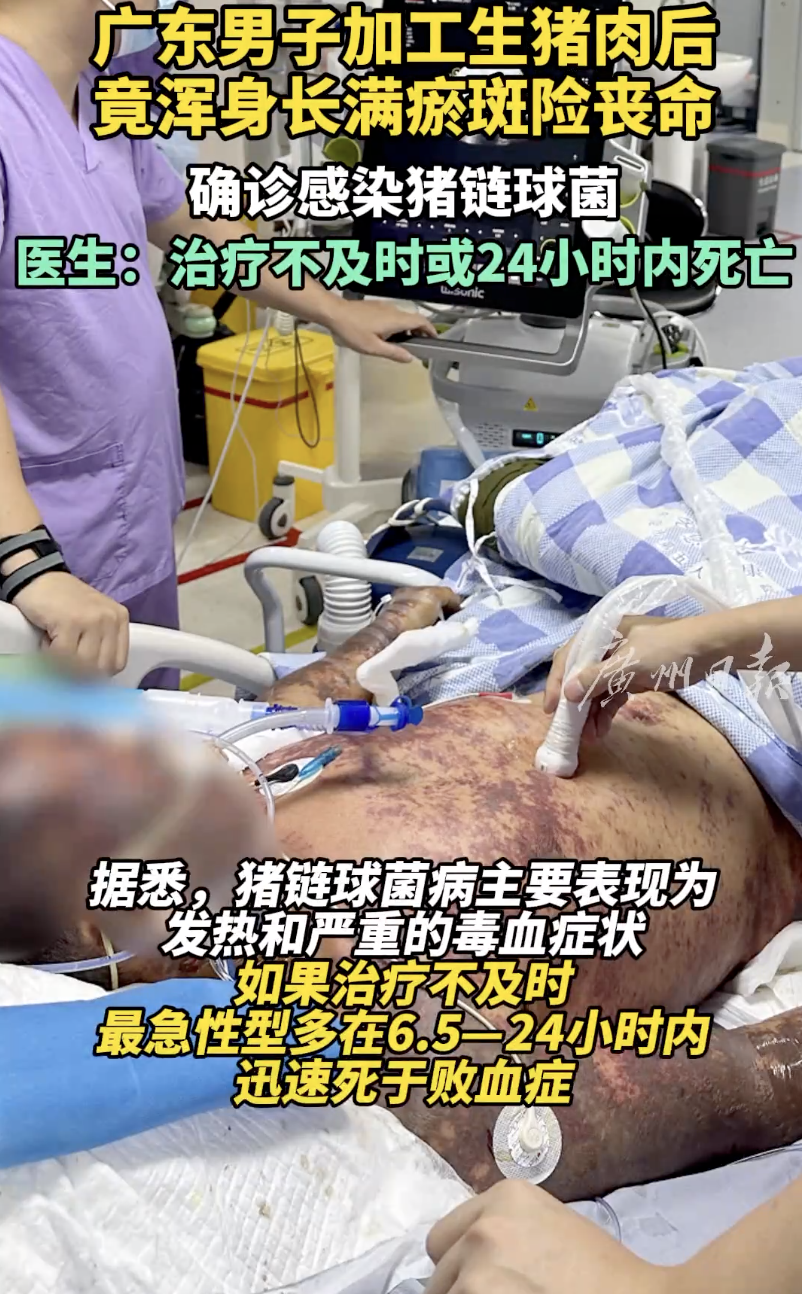 广东一男子接触猪肉后长满瘀斑,住进icu