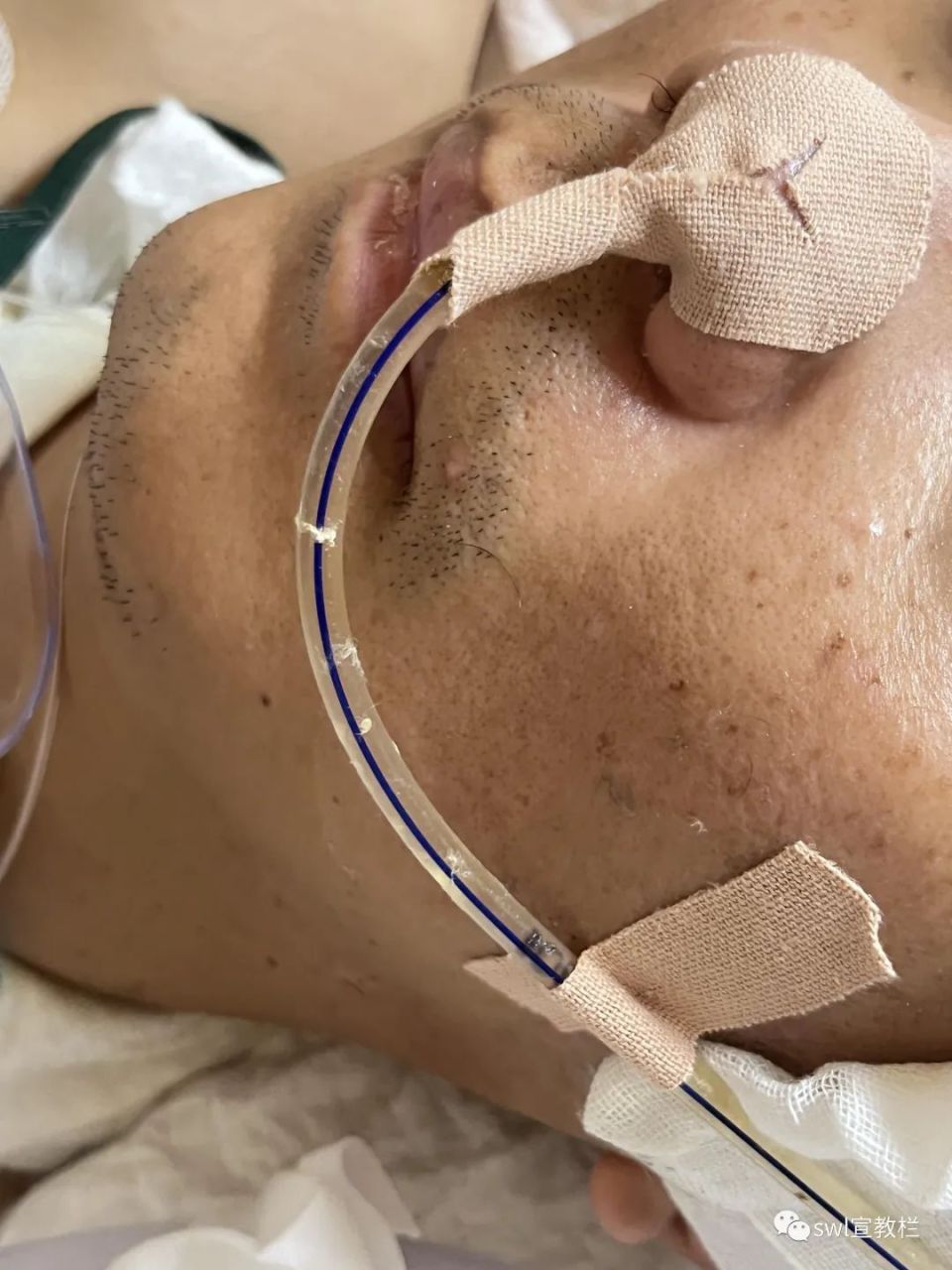 v形鼻贴固定工型鼻贴固定常用固定方法:3翻身时注意勿扯到胃管,翻身或