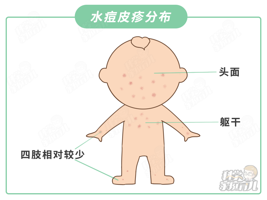 水痘会传染给别人吗图片