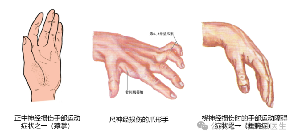 正中神经——猿手尺神经——爪形手桡神经——垂腕