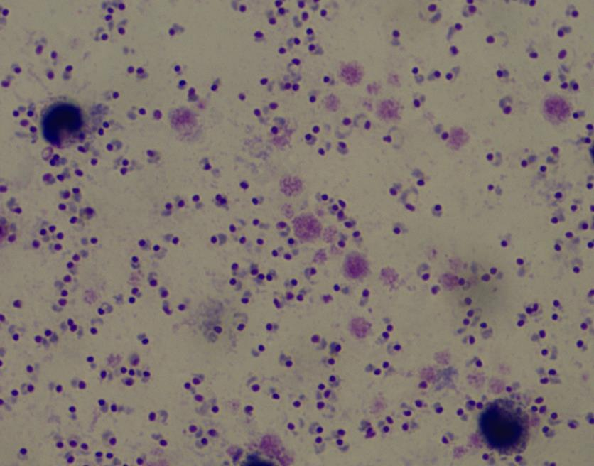 疟原虫厚血膜图片