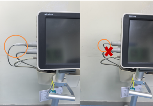 心电监护仪的导联线老打结？一个输液器排气帽解决问题！_https://www.jmylbn.com_新闻资讯_第4张