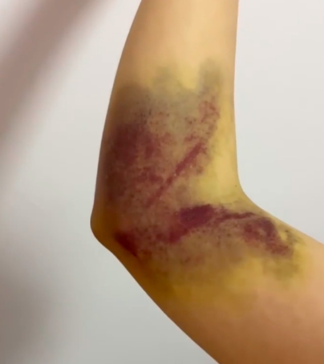 女生抽血后手臂淤青发黑,"后来还晕倒了,手臂都伸不直",院方回应:可能