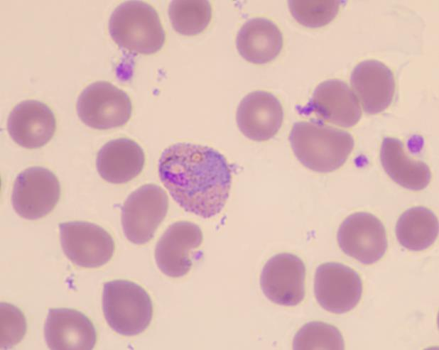 1个红细胞内含2个间日疟的大滋养体9,间日疟雌配子7,8间日疟雌配子体