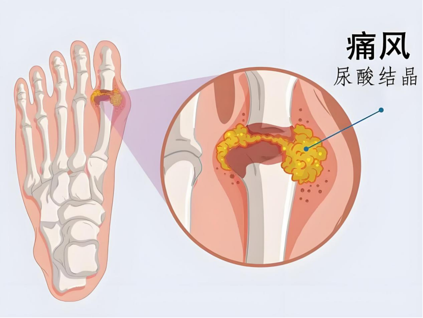 痛风开始年轻化?多注意这几点!