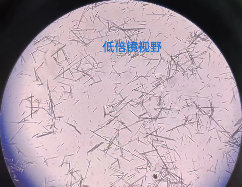 胰腺炎患者发现药物结晶一例