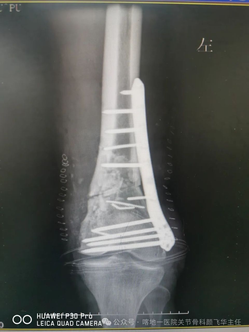 案例二:患者双侧膝内翻,o型腿,双膝内侧骨性关节炎