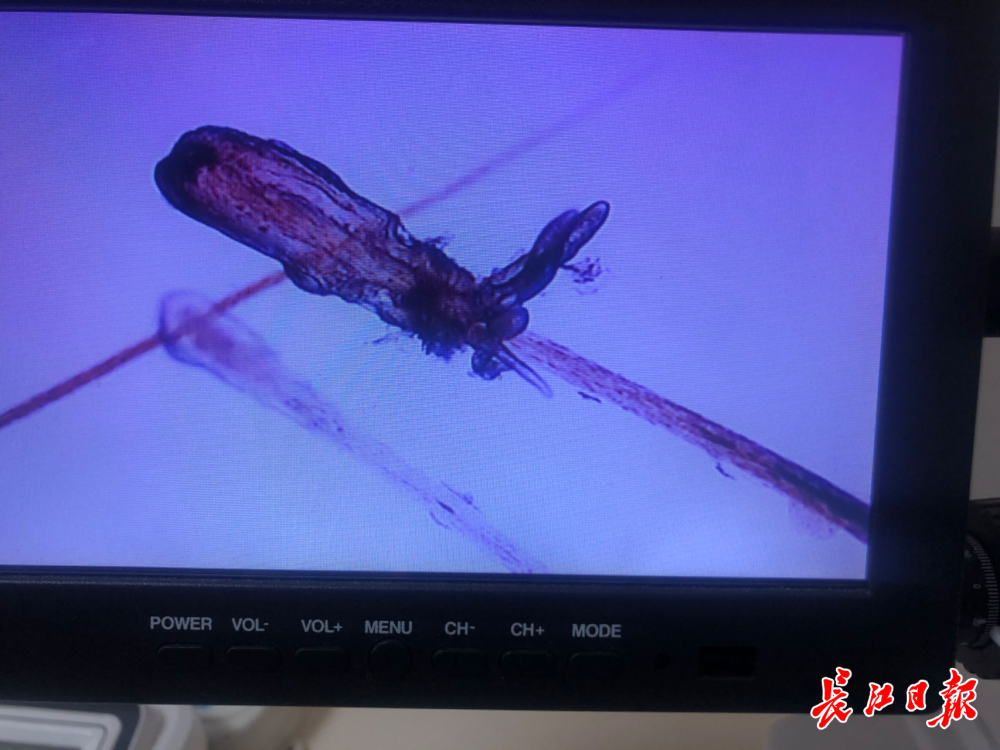 14岁女孩睫毛毛囊里"拔"出21条螨虫